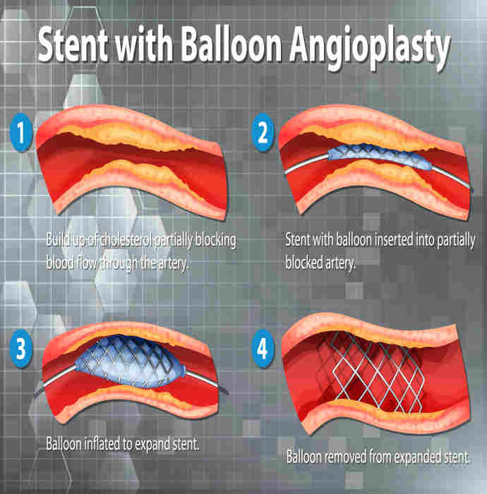 Angiogram ( CAG) 