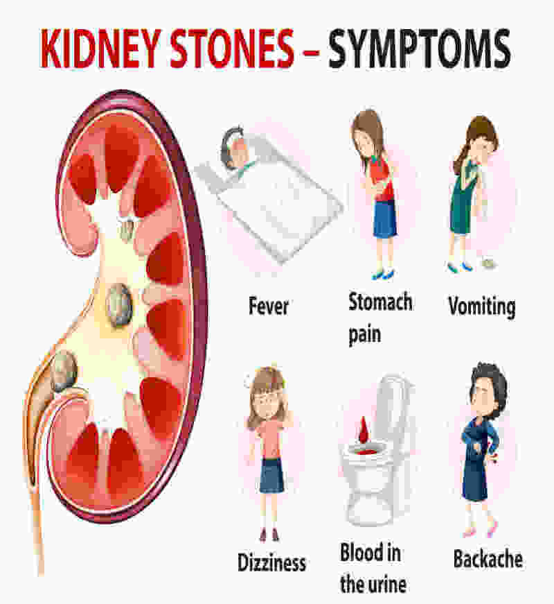 Kidney stones surgery 