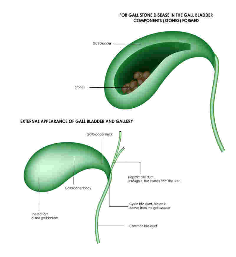 Gall Bladder Stone surgery 